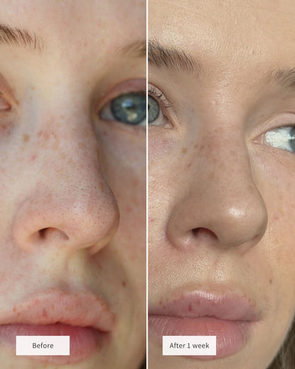 Veu | Hydrocolloid Nose Patches