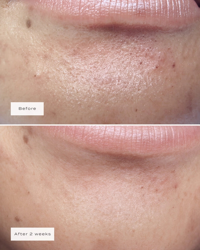 Veu | Chin Patches