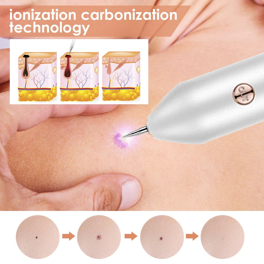 Velura™ | Mole & Skin Tag Removal Pen