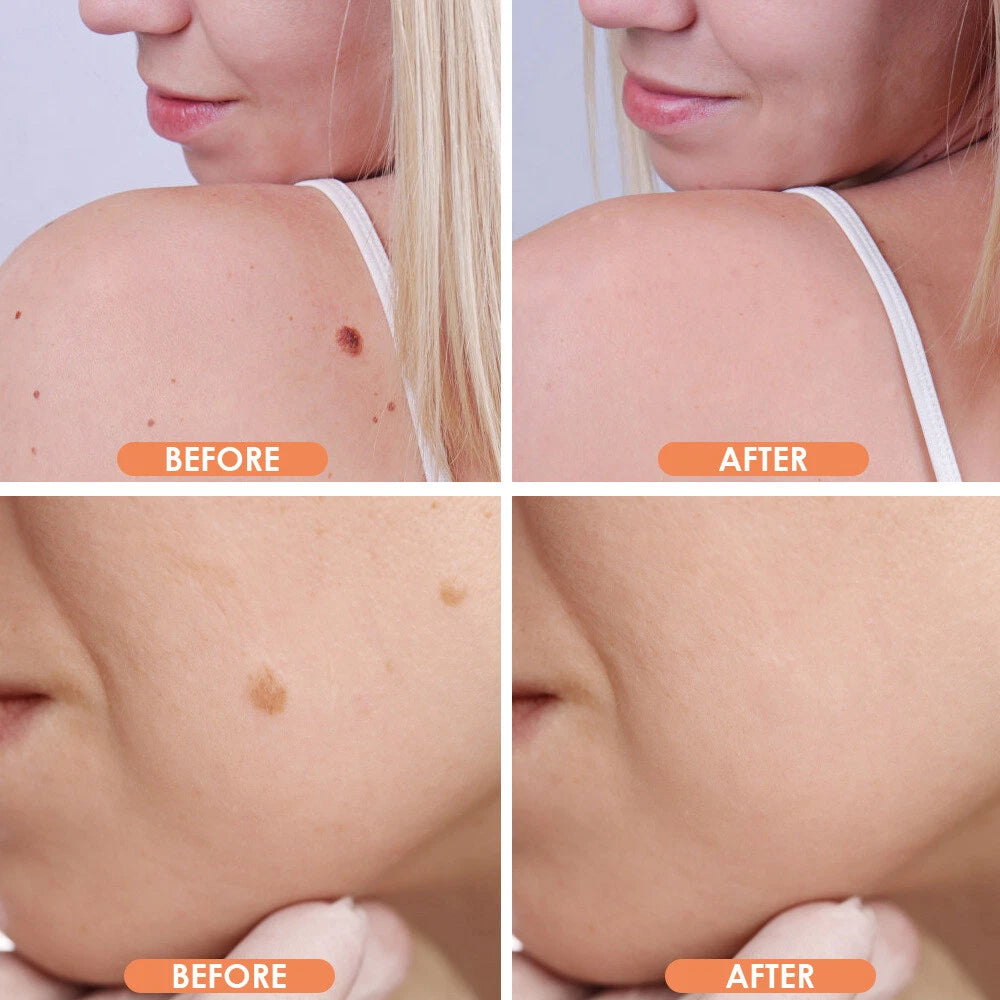 Velura™ | Mole & Skin Tag Removal Pen